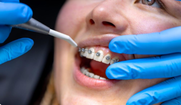 Orthodontic Treatments